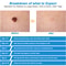 Professional Auto Skin Tag Remover Device, Standard & Micro Kit for Warts, Moles, and Face Care