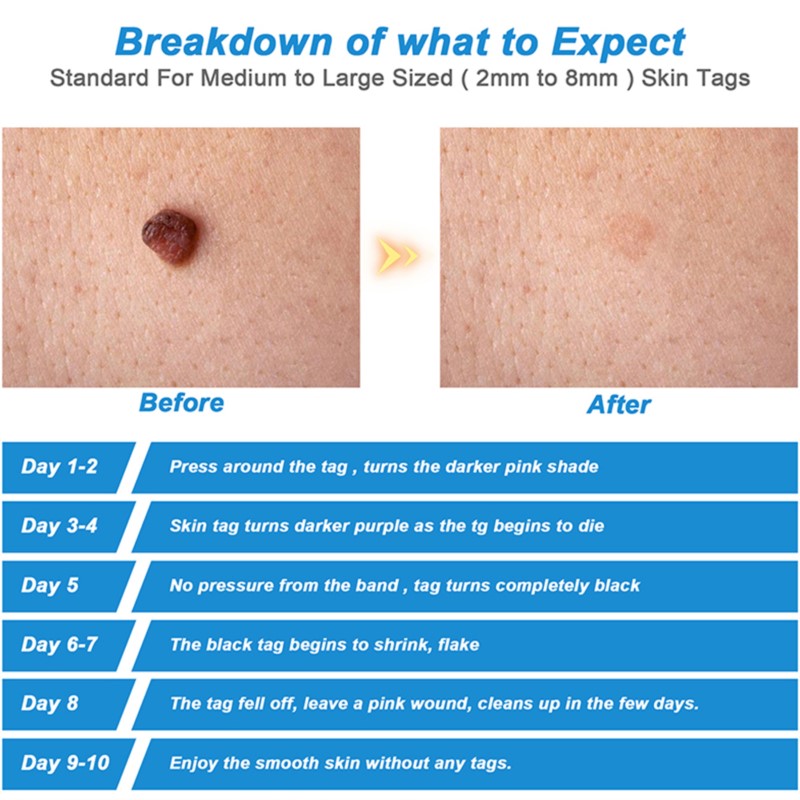 Professional Auto Skin Tag Remover Device, Standard & Micro Kit for Warts, Moles, and Face Care