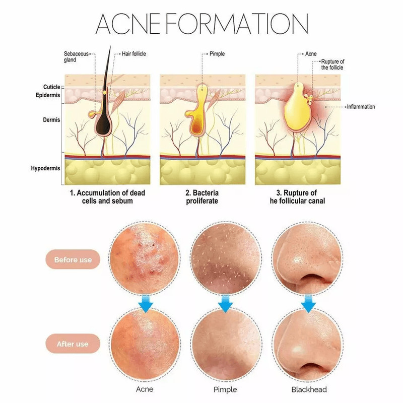 Blackhead Remover Kit Stainless Steel Pimple Popper Tools Comedone Extractor Set For Acne Zit White 2