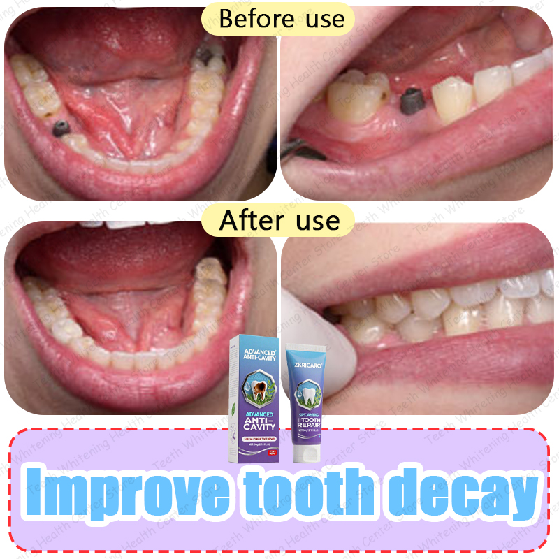 Advanced Tooth Decay Repair Toothpaste Enamel Strengthening Formula For Cavity Prevention Sensitivi 1
