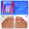 Onychomycosis Infrared Light, Wireless Nail Fungus Laser Device for Toenails, Blue Light Anti Fungal Laser Equipment