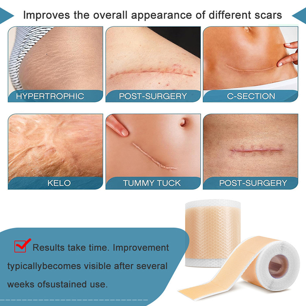 Medical Grade Silicone Scar Sheet Painless Effective Scar Repair Tape Silicone Scar Tape For Surgic 5