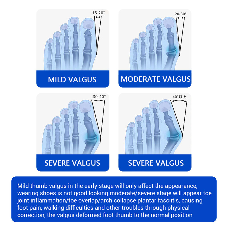 Toe Separator, Bunion Corrector, Foot Hallux Valgus Braces, Toe Straightener, Foot Care Tool, Bone Adjuster