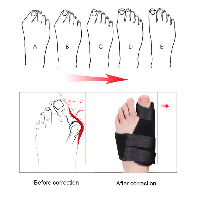 Toe Separator Splint 2pcs Soft Bunion Corrector Hallux Valgus Correction System Device Foot Care Pe 4