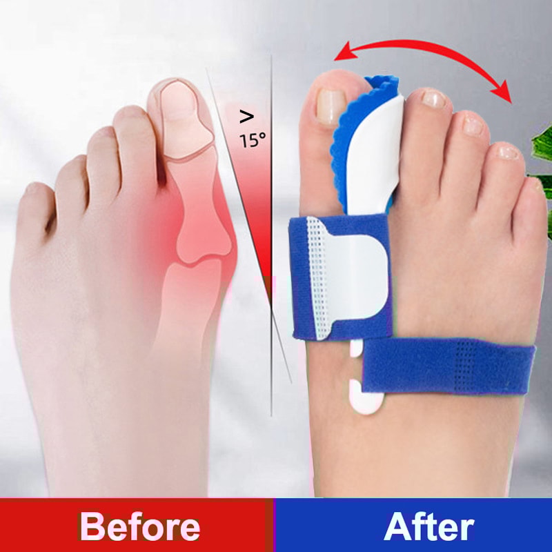 Orthopedic Braces Toe Correction Bunion Device Hallux Valgus Night Foot Care Corrector Thumb Daily 1
