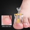 Stainless Steel Ingrown Toenail Lifter Nail Straighten Clip Paronychia Corrector Foot Care Tool 1