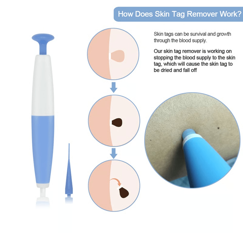 Painless Skin Tag Removal Kit For Small To Medium Size Skin Tags 1