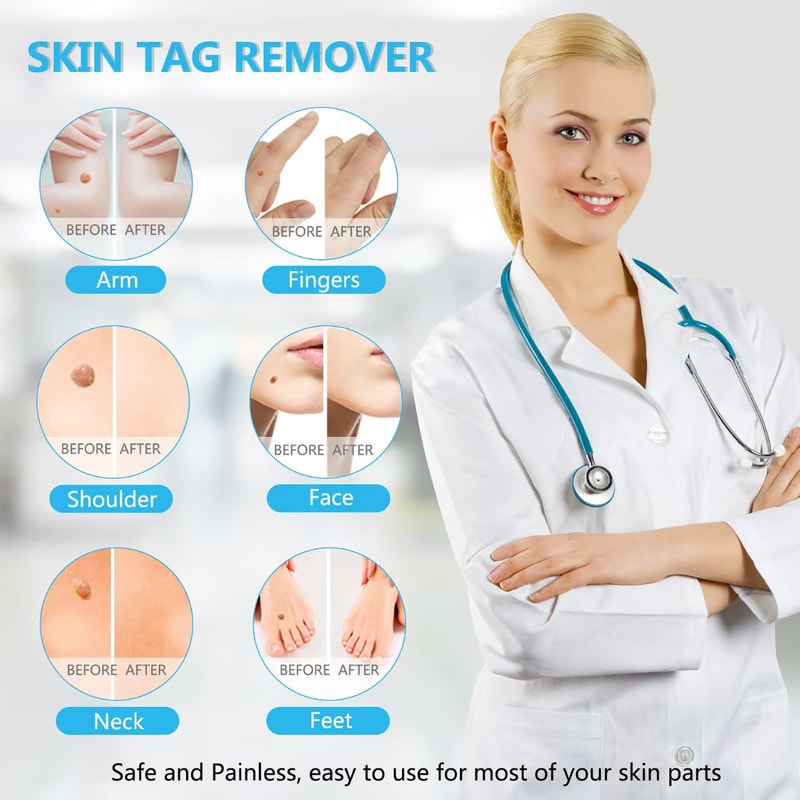 3-in-1 Skin Tag & Mole Removal Kit - Fast, Painless Treatment for Clear Skin at Home
