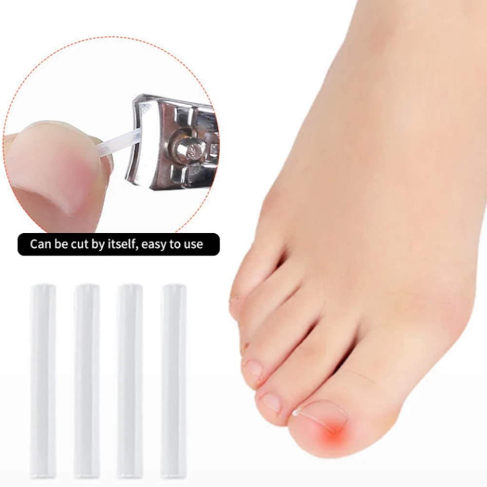 Ingrown Toenail Corrector Kit Nail Brace Filling Pad for Pain Relief