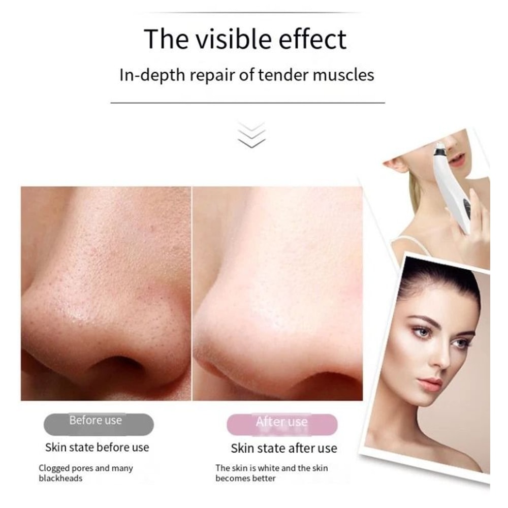 Electric Blackhead Remover Vacuum With Diamond Pore Suction For Glowing Skin 7