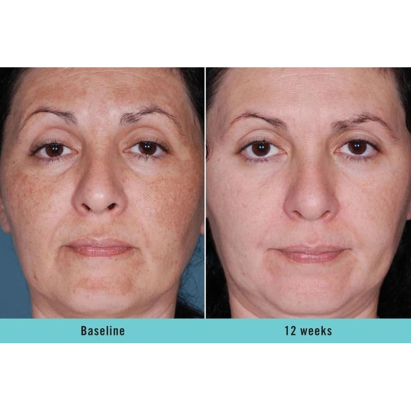 Kojic Acid Skin Whitening Brightening Serum Dark Spot Corrector For Even Skin Tone 3