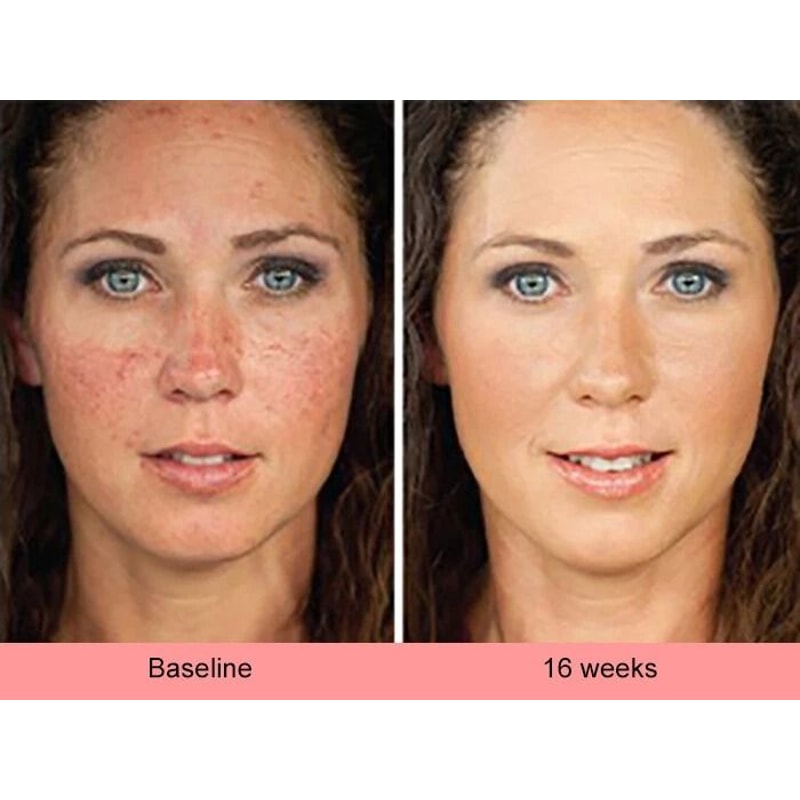 Kojic Acid Skin Whitening Brightening Serum Dark Spot Corrector For Even Skin Tone 5