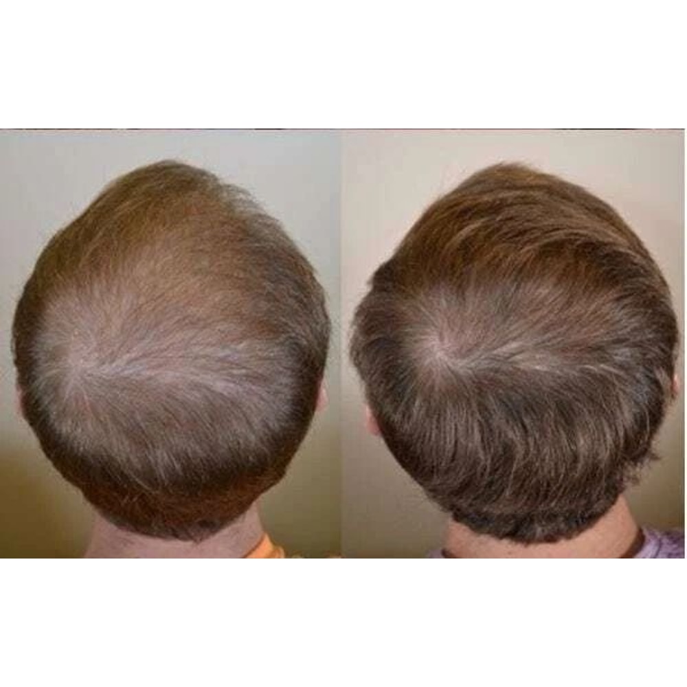 Best Hair Loss Conditioner With 16 Organic Oils For Fast Hair Growth DHT Blocker Therapy For Men W 2