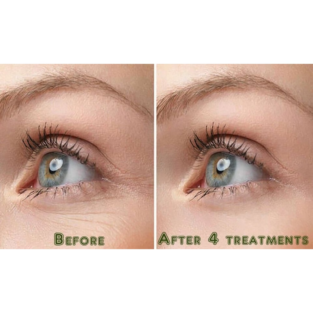 Lactic Acid Skin Peel Pure Organic Aloe Vera Gel Moisturizer Combo Exfoliate Hydrate 1