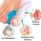 Silicone Gel Bunion Corrector Toe Separator For Big Toe Foot Pain Relief 2