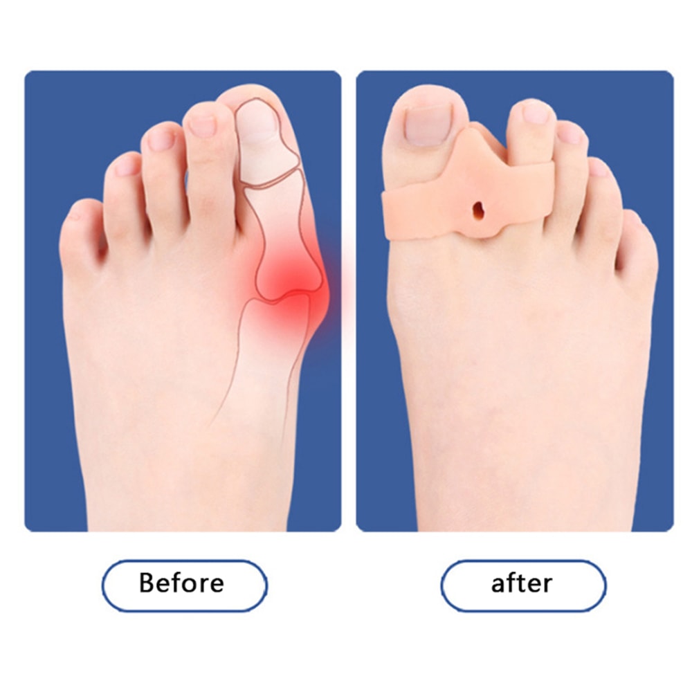 Hallux Valgus Corrector - Silicone Toe Separator for Pain Relief and Foot Straightening