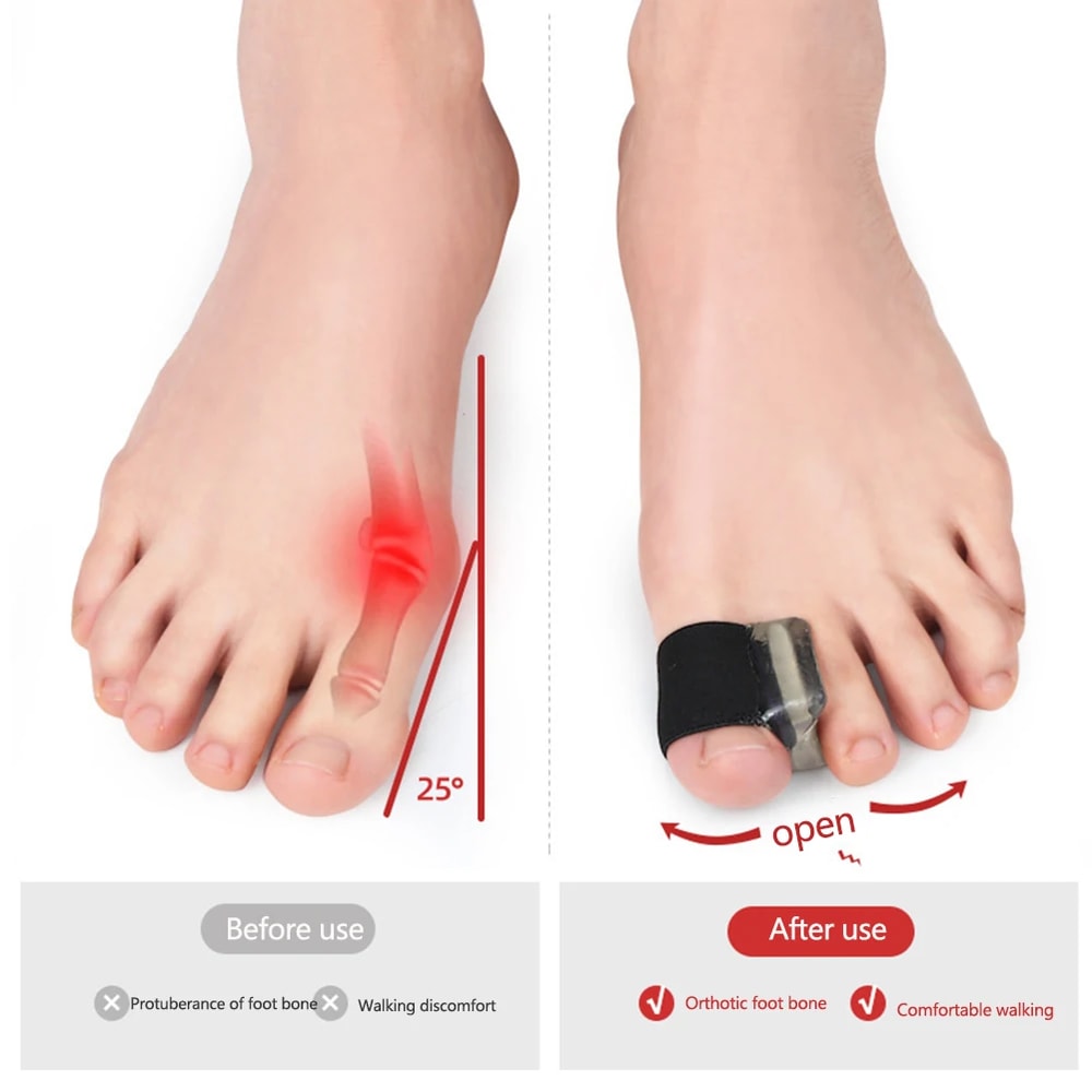Silicone Bunion Corrector Toe Straightener Soft Hallux Valgus Brace For Daily Foot Alignment Pain 2