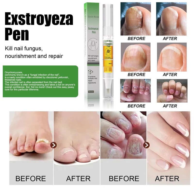 Advanced Nail Fungus Treatment Pen For Toenail Infection Repair And Brightening Care 3