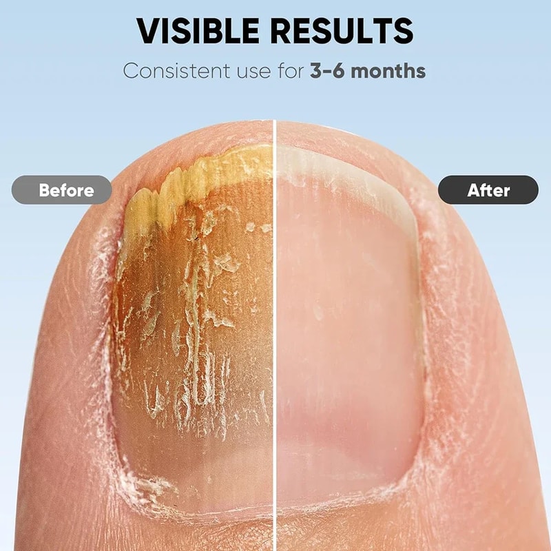 Laser Nail Fungus Treatment Device With Blue Light Therapy USB Rechargeable Onychomycosis Care 4