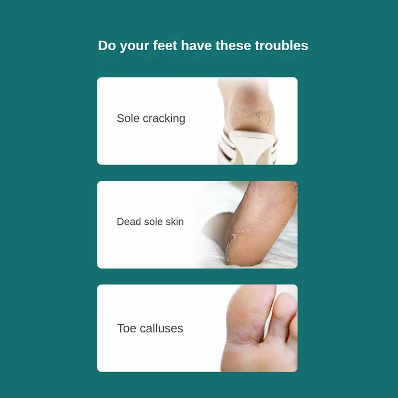 SmoothStep Pro Foot Callus Remover Kit Stainless Steel Foot Callus Remover For Soft Healthy Feet 3