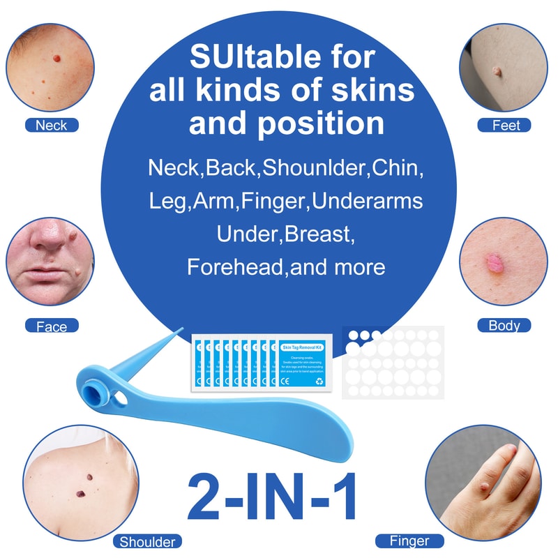 SmoothClear Skin Tag Mole Removal Kit Painless Skin Tag Remover For Home Use 3