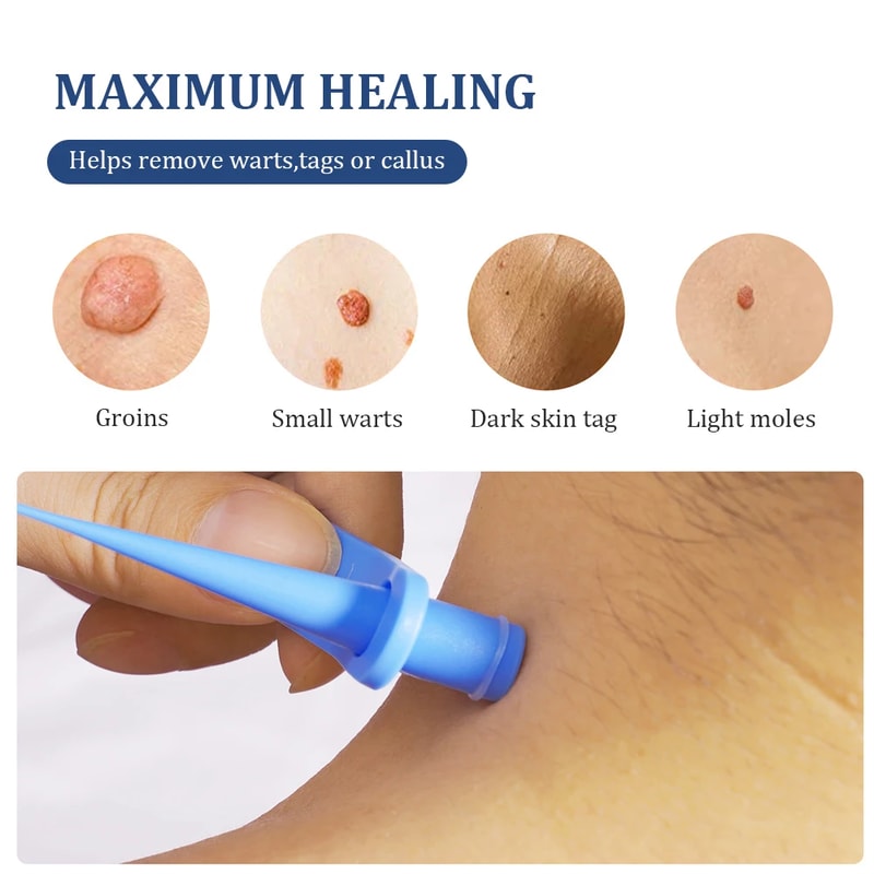 SmoothClear Skin Tag Mole Removal Kit Painless Skin Tag Remover For Home Use 5