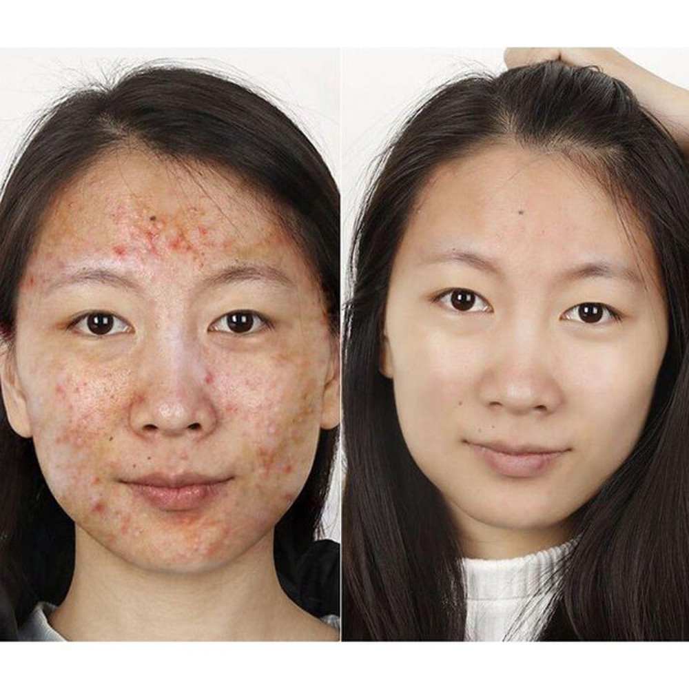 Before and after using TCM Acne Scar Cream for clear skin