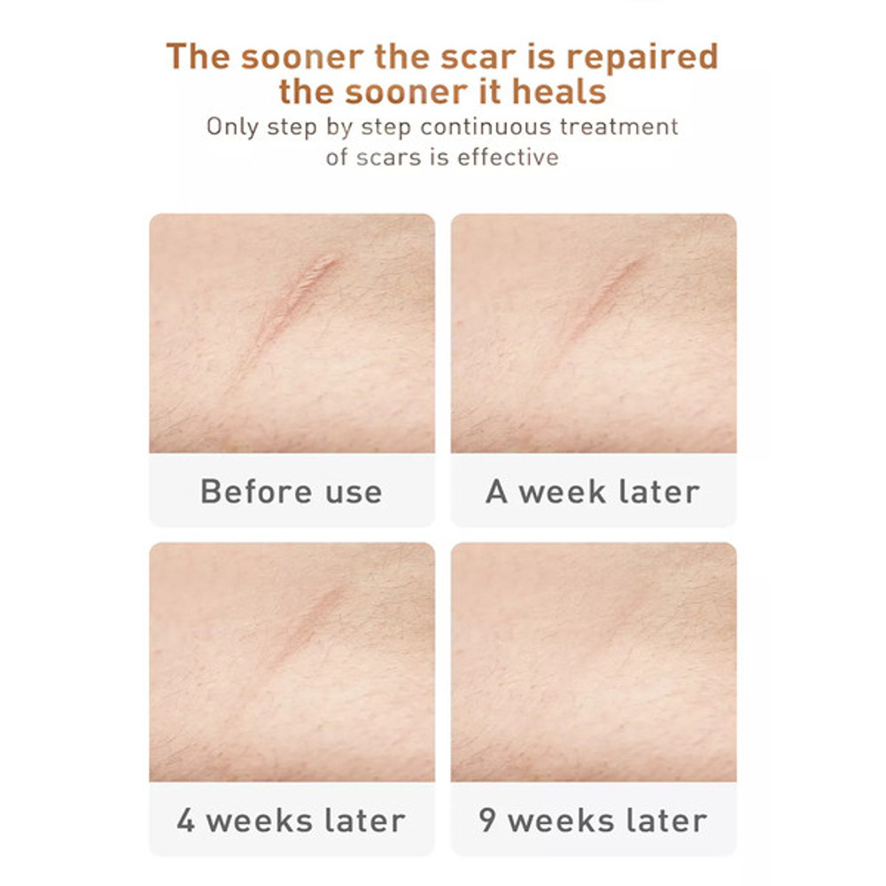 TCM Acne Scar Cream 6