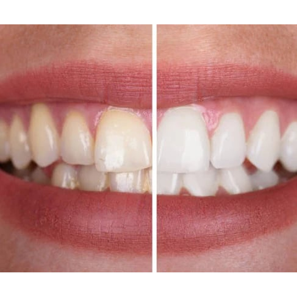 Teeth Colour Corrector Serum 4