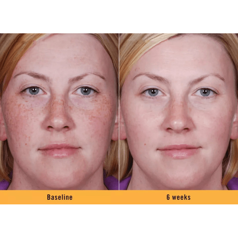 Kojic Acid Skin Whitening Serum Ultra Brightening Dark Spot Corrector With Niacinamide  Vitamin C 1