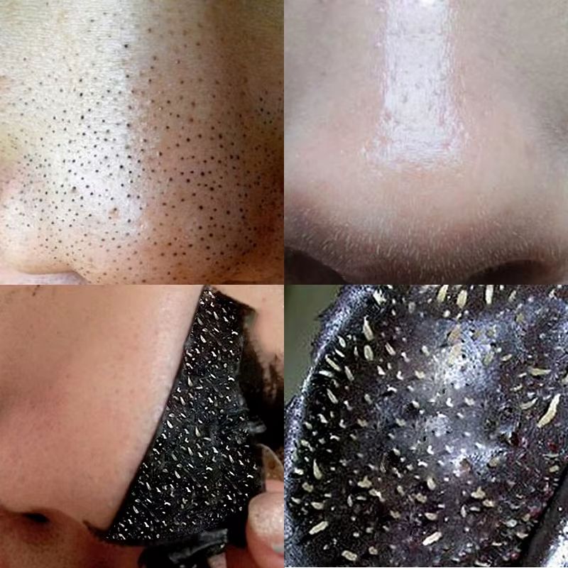 Nose Blackhead Removal Sticker Strips 2