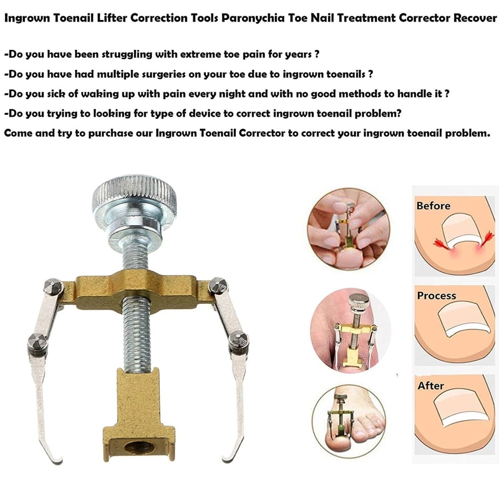 Ingrown Toenail Correction Lifter Tool Fixer For Toenail Straightening And Ingrown Toenail Treatme