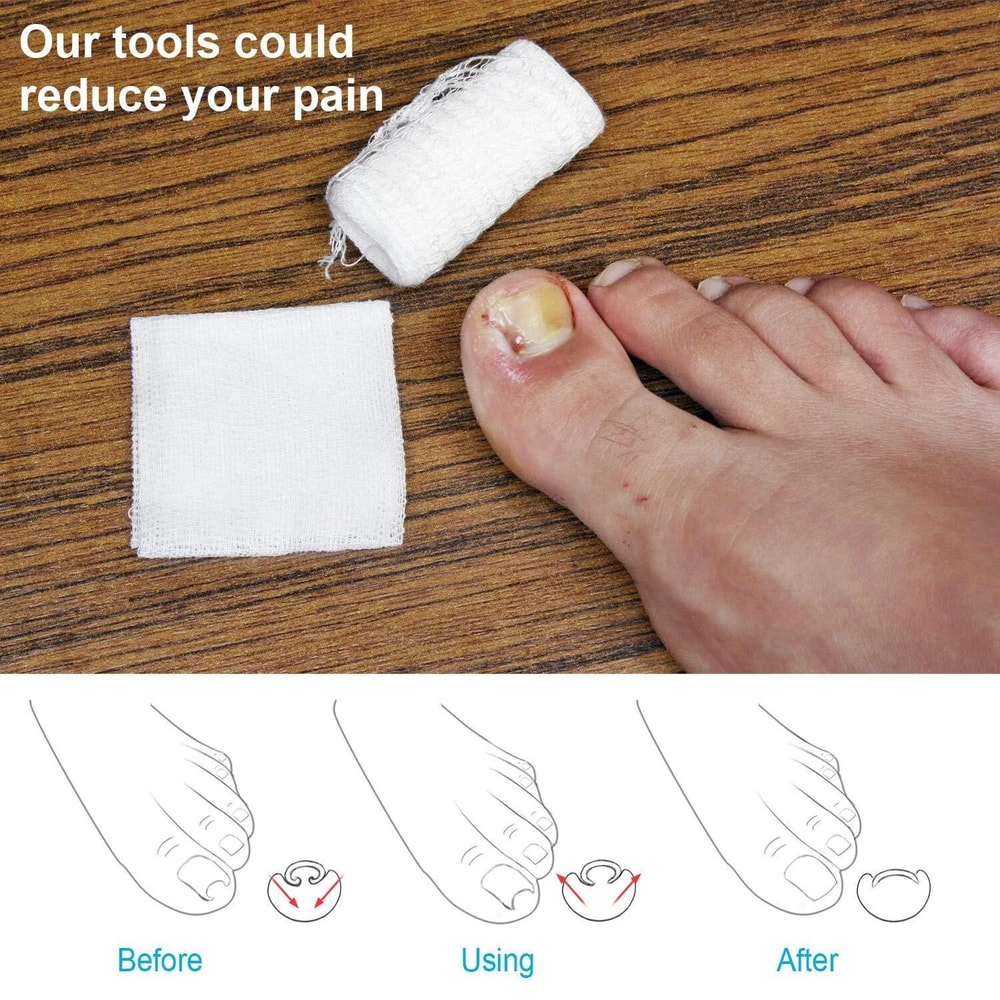 Ingrown Toenail Correction Lifter Tool Fixer For Toenail Straightening And Ingrown Toenail Treatme