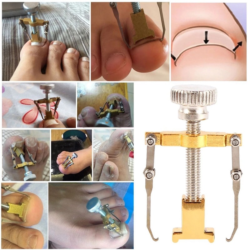 Ingrown Toenail Correction Lifter Tool Fixer For Toenail Straightening And Ingrown Toenail Treatme