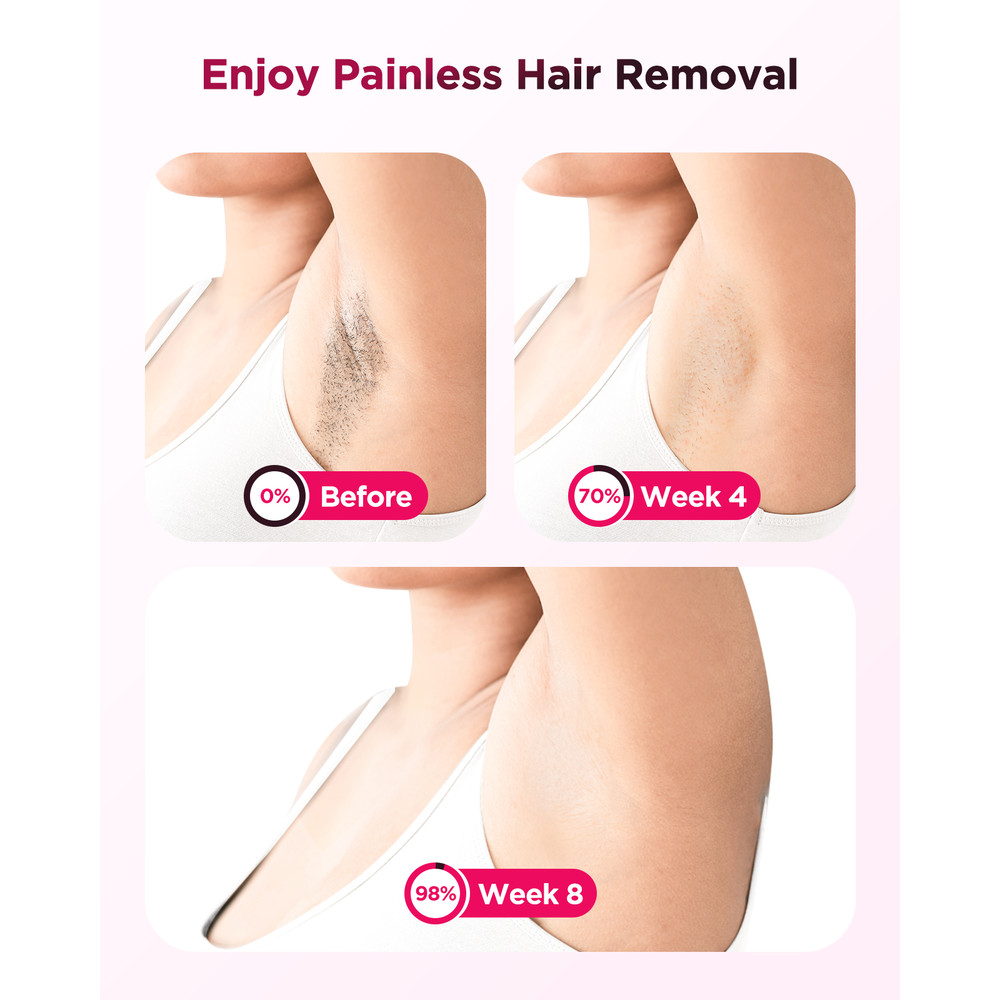 At Home IPL Hair Removal Machine 990K Flashes For Full Body Use Painless Clinically Effective Unde 5