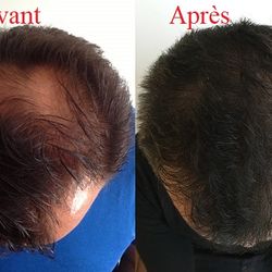 hemp oil against hair loss