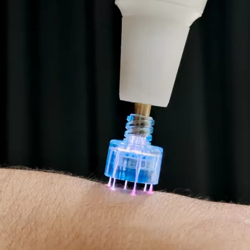 Professional Fusion Plasma Laser Pen with Ozone & Cold Spray, Fibroblast Mole, Wart, Skin Tag Removal & Cold Bleaching