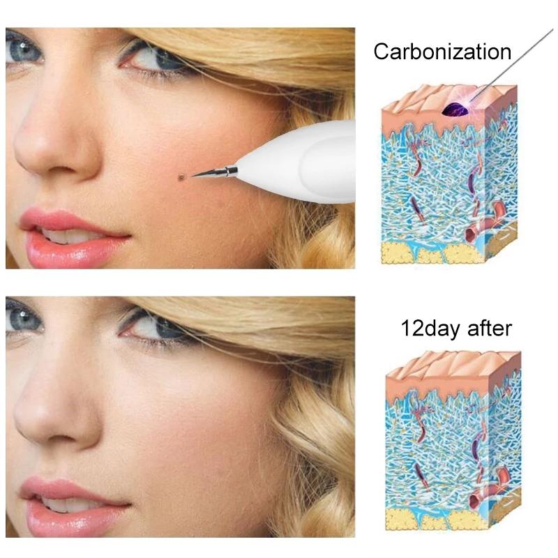 USB Plasma Pen Dark Spot Remover for Freckles Warts and Skin Tags