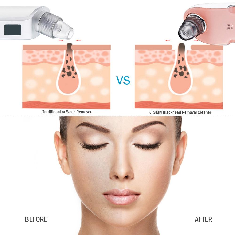 Rechargeable Blackhead Remover Pore Vacuum Facial Cleaner 3