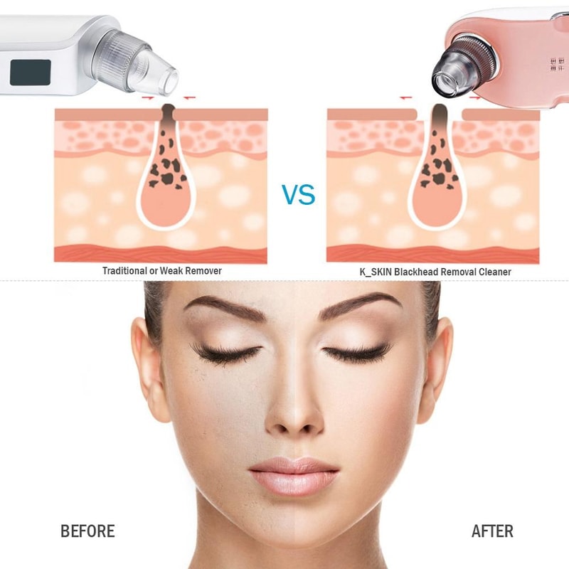 Rechargeable Blackhead Remover Pore Vacuum Facial Cleaner 3