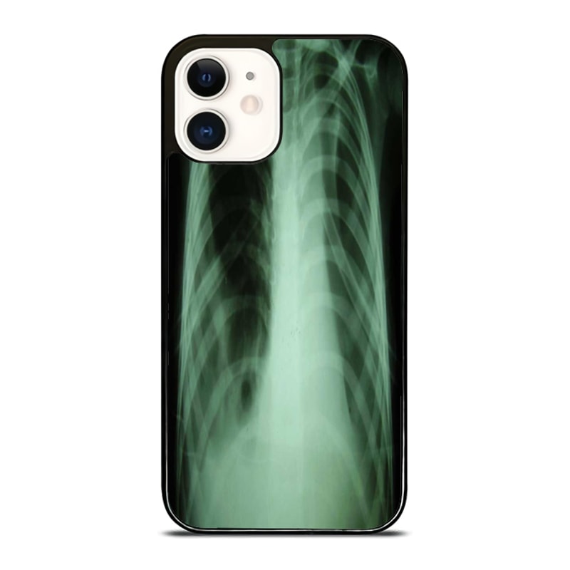 Chest XRay Custom IPhone Case Personalize Your Style Today 0