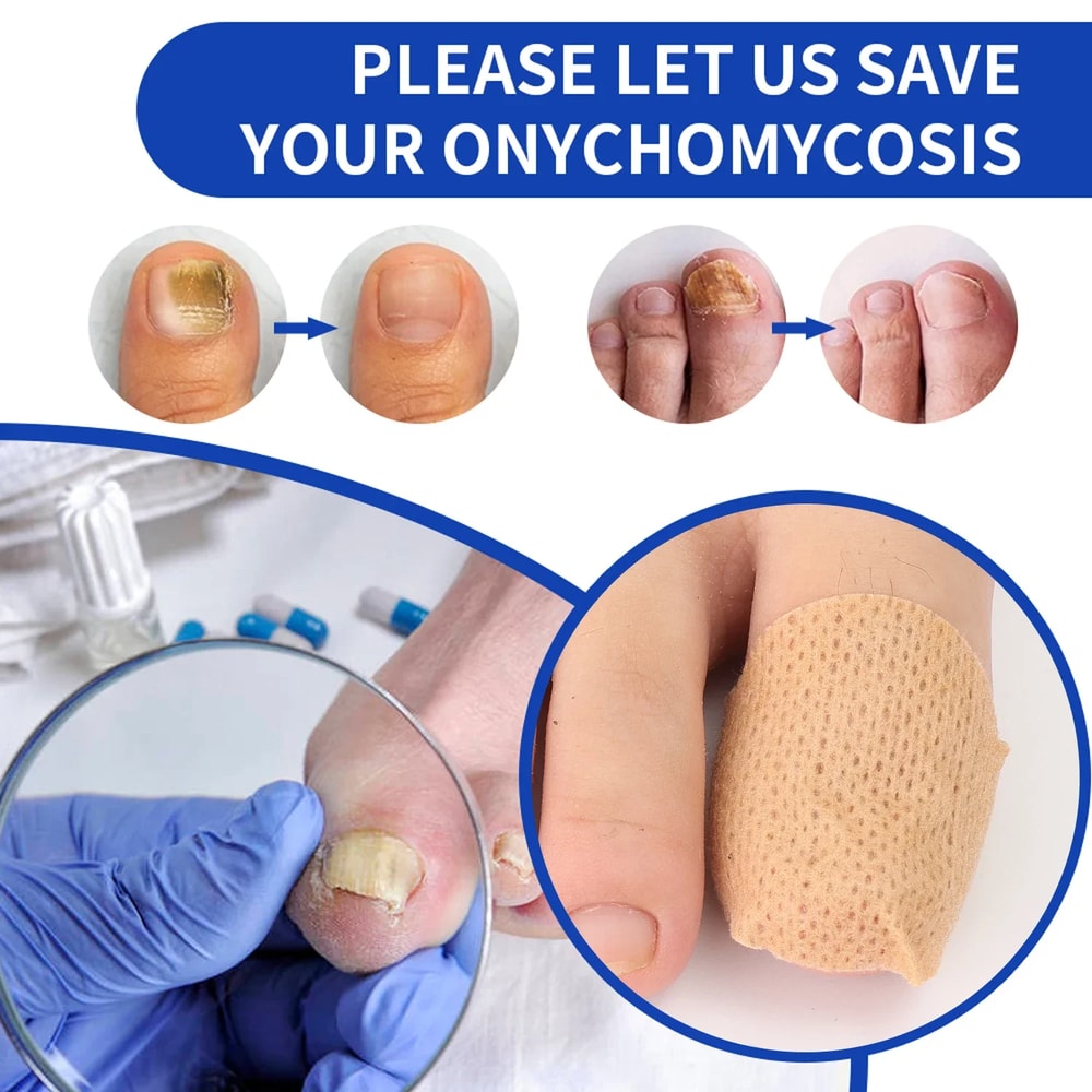 FungiShield Waterproof Nail Fungus Treatment Patch Ingrown Toenail Correction Stickers 4