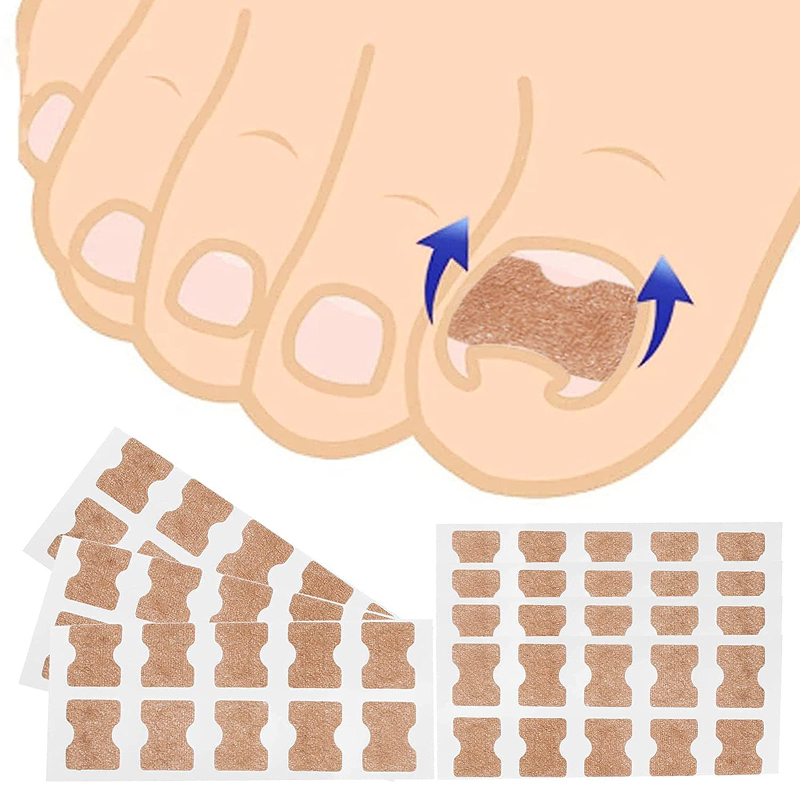 Precision Ingrown Toenail Corrector Clip Kit For Gentle Nail Straightening And Foot Care 1