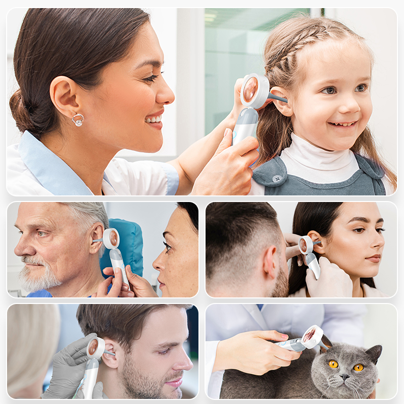 SmartView HD Ear Wax Removal Camera with Visual Otoscope & Rotating Lens