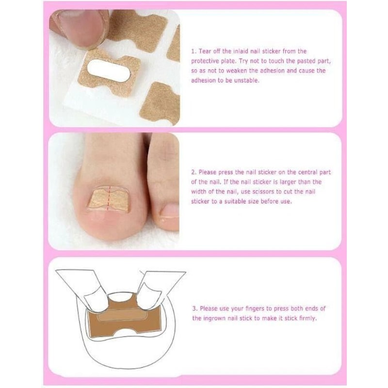 Toenail Corrector Sticker Ingrown Toe Foot Nail Fix Pedicure Tool For Quick Relief And Healing 1