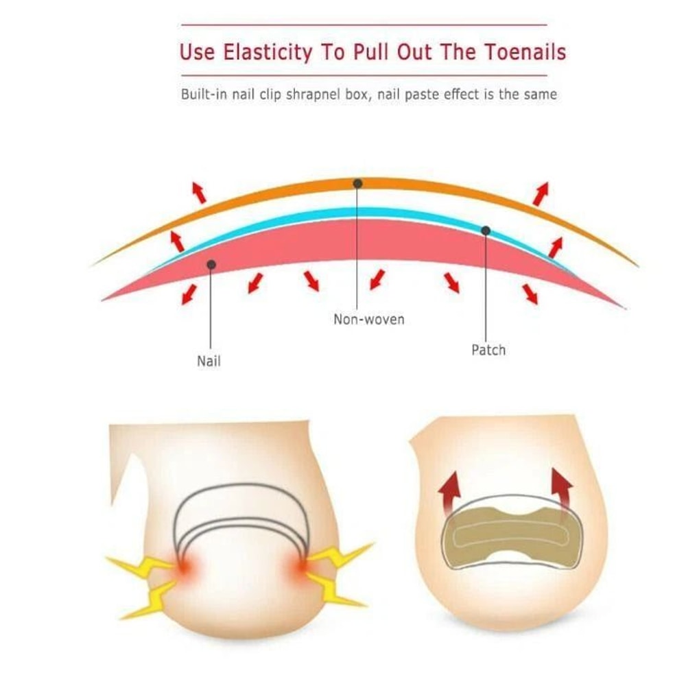 Toenail Corrector Sticker Ingrown Toe Foot Nail Fix Pedicure Tool For Quick Relief And Healing 2