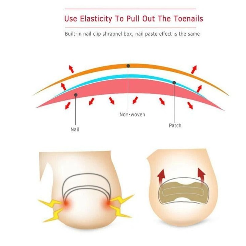 Toenail Corrector Sticker Ingrown Toe Foot Nail Fix Pedicure Tool For Quick Relief And Healing 2