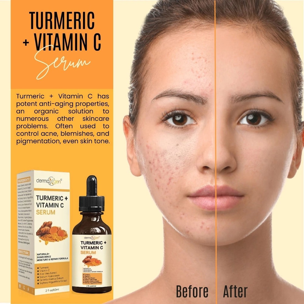 Turmeric Face Serum For Acne Dark Spots And Pigmentation Blemish Corrector Skin Brightener 3