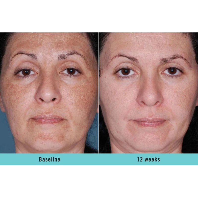 Kojic Acid Dark Spot Corrector Brightening Serum With Niacinamide And Vitamin C 3