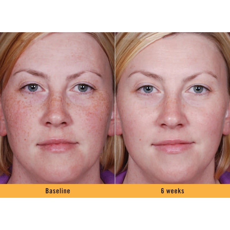 Kojic Acid Dark Spot Corrector Brightening Serum With Niacinamide And Vitamin C 5